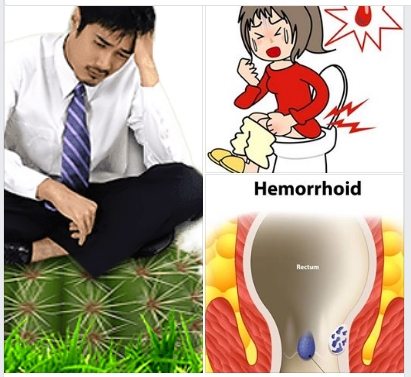 Bệnh trĩ hình thành như thế nào? Chủ yếu liên quan đến 4 yếu tố này!
