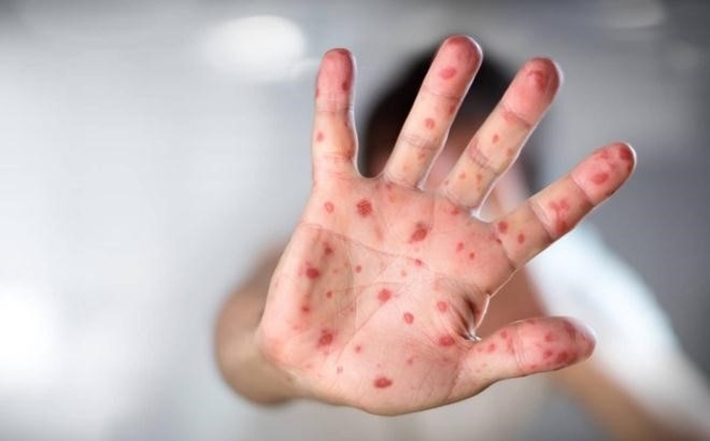 BỆNH TAY CHÂN MIỆNG: DẤU HIỆU NHẬN BIẾT VÀ CÁCH PHÒNG TRÁNH