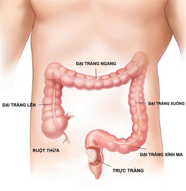 Giới thiệu chung về bệnh học Ung thư đại tràng - trực tràng