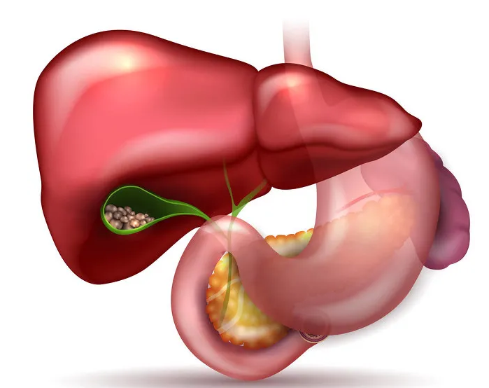 Những tình huống nào dễ gây sỏi cholesterol?