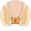 Nứt hậu môn